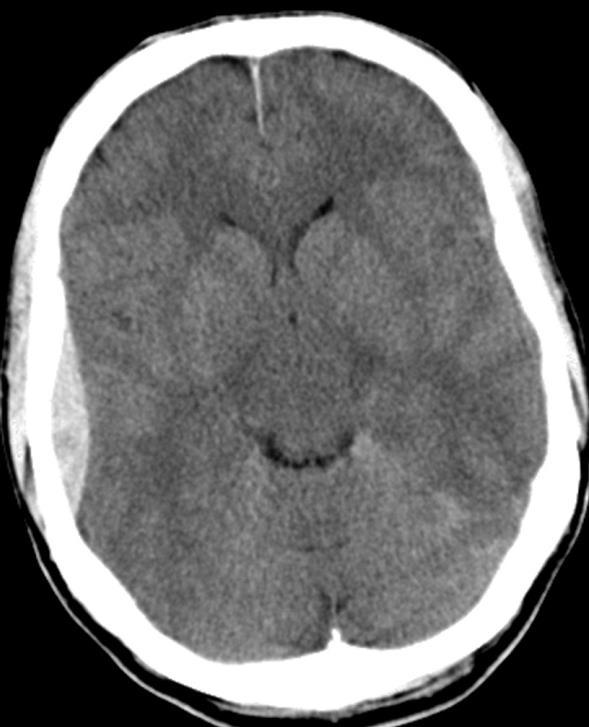Patología traumática Fig. 1 Hematoma epidural temporal derecho.