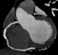 otros métodos no invasivos Evaluación cuantitativa de la función ventricular derecha Evaluación de la morfología ventricular derecha (Sospecha de DAVD) Caracterización de las valvas cardiacas nativas