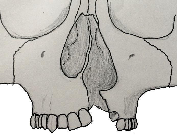 25 Figura No. 6. Vista anterior de región nasomaxilar con fisura palatina. Nótese que el ala nasal derecha se encuentra más inferior que la del lado opuesto.