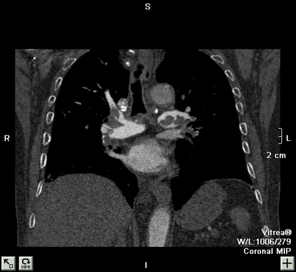 Fig. 6: TEP masivo y central Reconstrucción coronal de angio-tc de arterias pulmonares.