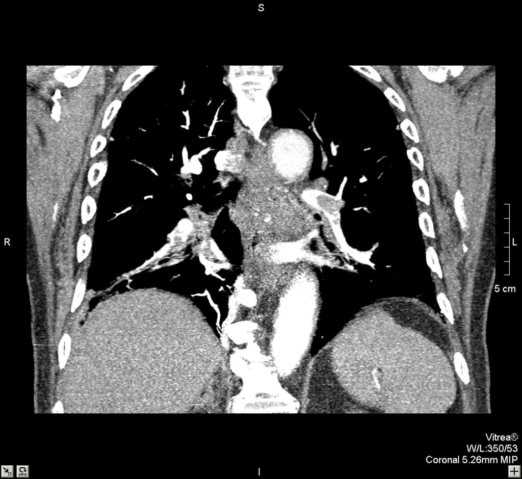 Fig. 7: TEP masivo Reconstrucción coronal de angio-tc de arterias pulmonares.