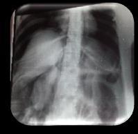 Rx de tórax y abdomen se evidencia: neumotórax bilateral hipertensivo y nefrograma derecho (Figura 2a); lo que sugiere: perforación retroperitoneal por CPRE.