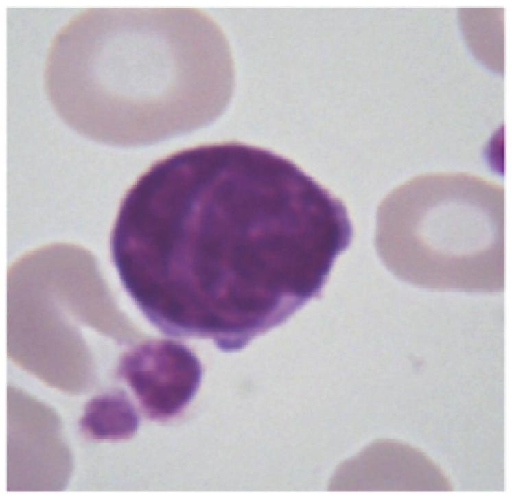 El síndrome de Sézary (SS) es considerado como la expresión leucemizada de la micosis fungoide (MF), caracterizándose por eritrodermia, poliadenopatías y un elevado número de linfocitos
