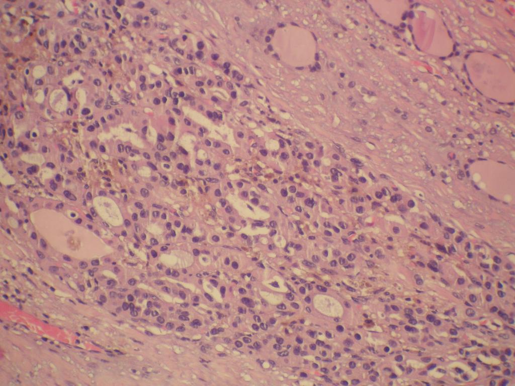 Fig. 11: Carcinoma oncocítico con