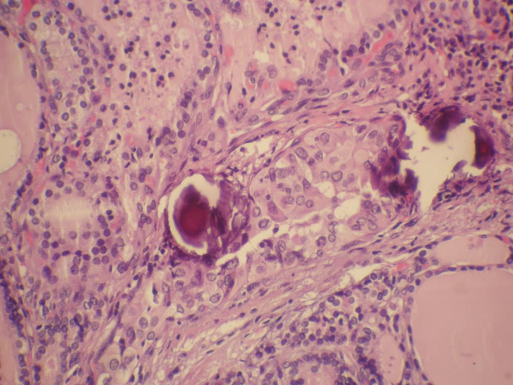Fig. 2: Carcinoma papilar.