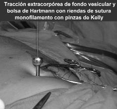 de Kelly fuera del abdomen, quedando libre la aguja gancho como auxiliar extra para la adecuada tracción vesicular y la exposición de los elementos.