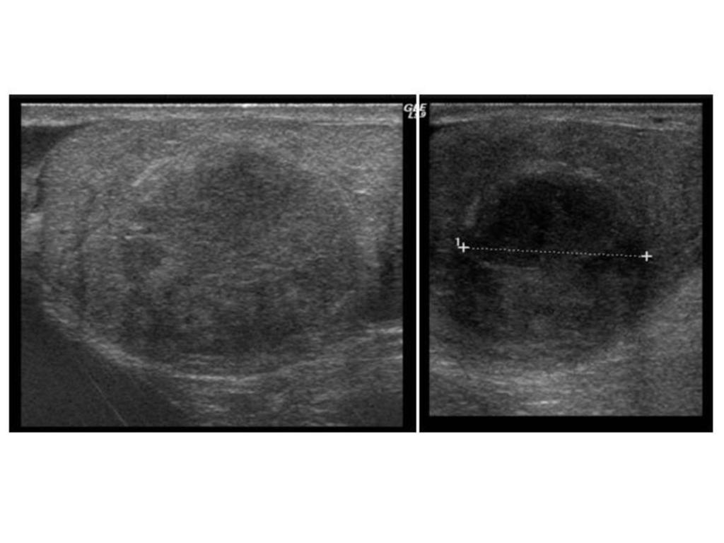 Fig. 8: En la imagen de la derecha vemos el estudio ecográfico inicial donde aparece una lesión bien delimitada, homogénea e hipoecoica que no mostró señal de flujo vascular