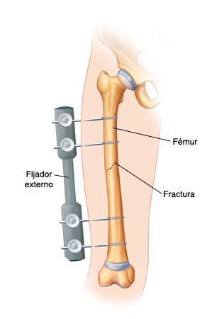 Prevención Estabilización temprana de las fracturas de