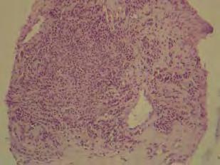 Caso Clínico Foto 5: Mesotelioma maligno bien diferenciado, variedad predominantemente epitelio. H/E. 10x. Discusión El mesotelioma es un tumor de las células del mesotelio.