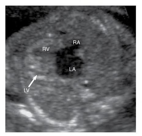 Diagnóstico DSAV completo con ventrículo