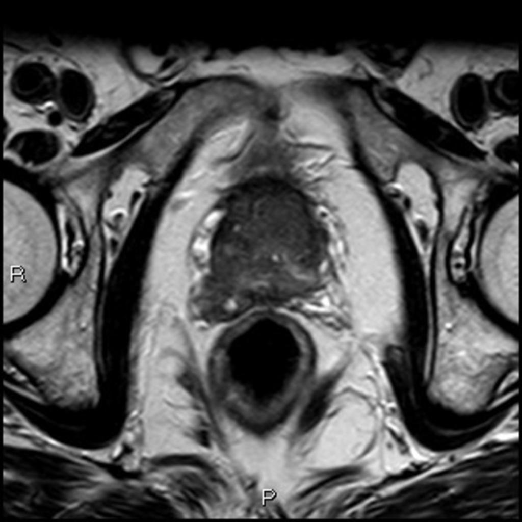 Fig. 1: Imagen T2 axial de tumoración prostática periférica que infiltra la