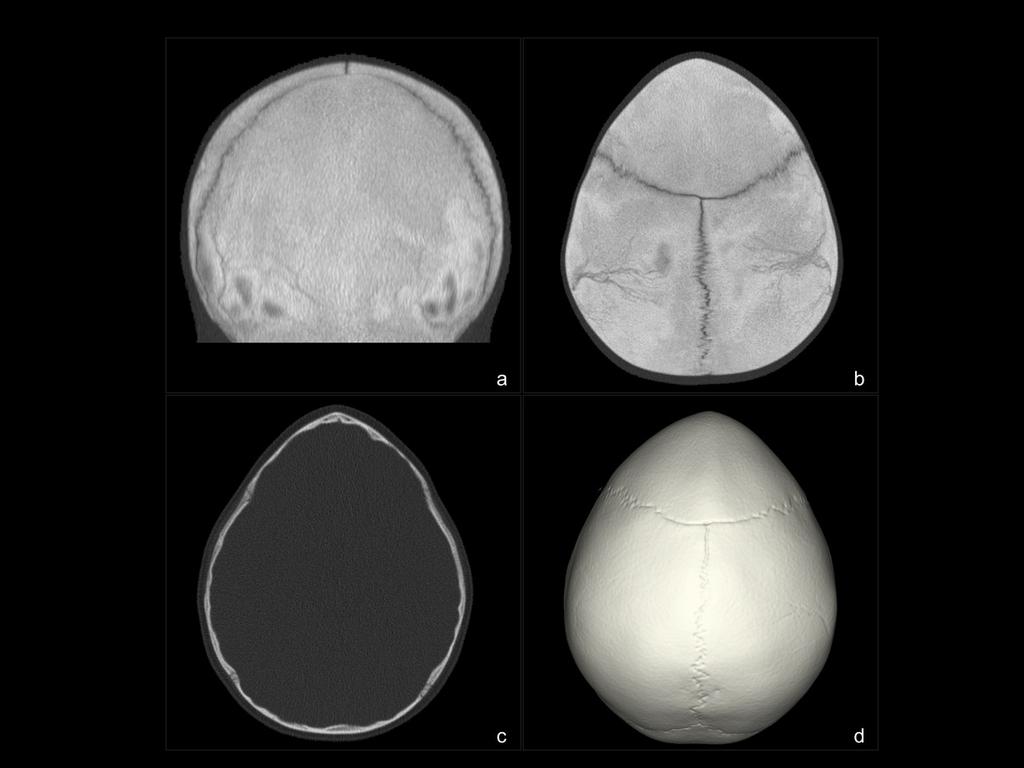 Fig. 2: Niño de 21 meses. Craneosinostosis de la sutura metópica, trigonocefalia.