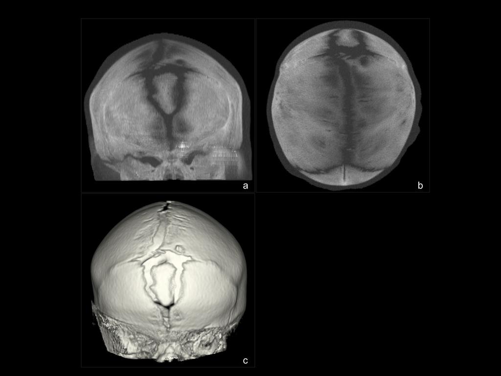 Fig. 3: Niño de 4 días. Craneosinostosis de la sutura coronal, bilateral y hueso bregmático.
