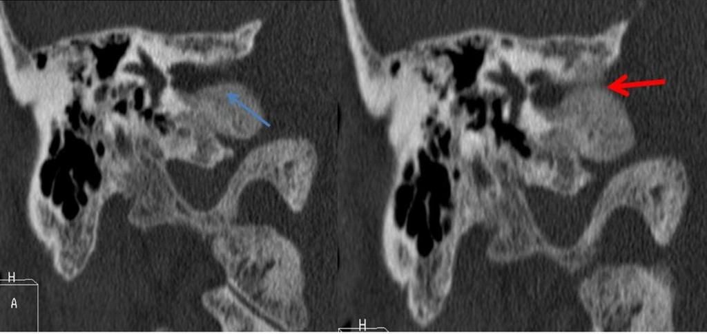 Fig. 3: Reconstrucción coronal que muestra alteración de la densidad ósea de mastoides y hueso petroso,