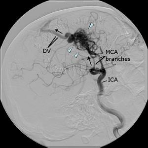 Angiografía Buscar: Los 3 componentes de una MAV: Arteria aferente dilatada Nido Vena de drenaje