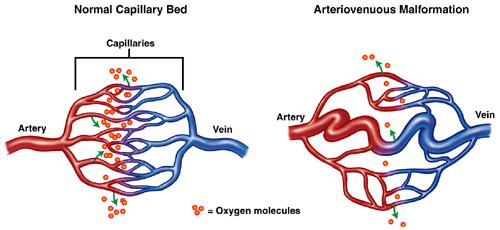 MAV: definición Shunt entre sistema arterial y venoso,