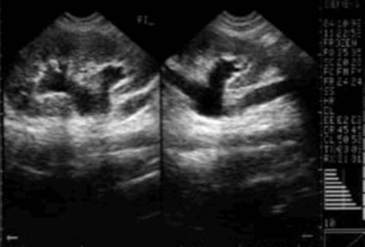 Ecografía Renal De elección en TODO paciente con Dg. Prenatal de dilatación de la vía urinaria. Consideraciones: No invasivo, barato fácil acceso, sin radiación, operador dependiente.