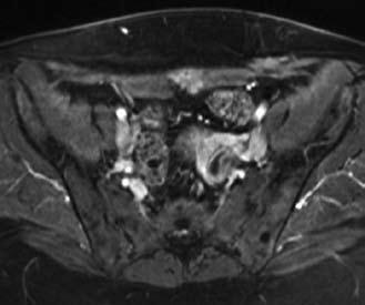 9b Figura 9. Cortes axiales (a y b) de RM en secuencia T1 con saturación grasa a nivel de cicatriz de episiotomía, en que se observan implantes endometriósicos hiperintensos.