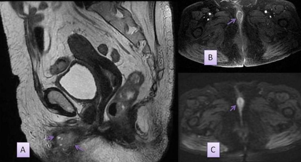 Fig. 2: T1 axial (A),Difusión (B) Y T1 con contraste en paciente con carcinoma de vulva en labio derecho (flecha). Fig.