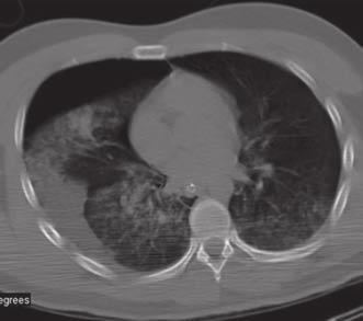 Figura 3. El corte axial muestra hidroneumotórax con zonas de contusión pulmonar. Figura 5.
