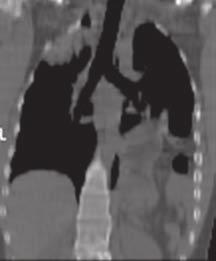 Los cortes axiales mostraron la falta de visualización del diafragma en la zona posterior del tórax, con
