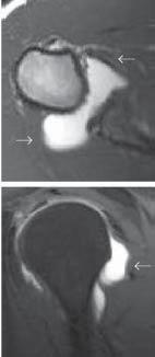 Se origina en el aspecto antero superior del labrum, junto con el LGHS, solo o con el ligamento glenohumeral inferior y se inserta en la base del troquín. Puede ser doble o redundante.