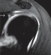Glenohumeral instability: evaluation using MR arthrography of the shoulder. Skeletal Radiol 1999; 28: 365-382. 2. Yang Hee Park, Ji Yeon Lee, Sung Hee Moon, Jong Hyun Mo, Bo Kyu Yang, Sung Ho Hahn, Donald Resnik.