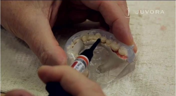 Flujo de dentina y encía: aplicación de dientes prefabricados 1)La aplicación del flujo de la dentina al modelo (armazón y dientes en silicona) se debe realizar inicialmente del lado oclusal y, a