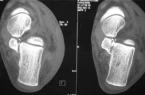 A. Dalmau Coll Figura 3. Imagen de tomografía computarizada de fractura de sustentaculum tali. Figura 4. Fractura de apófisis anterior del calcáneo.