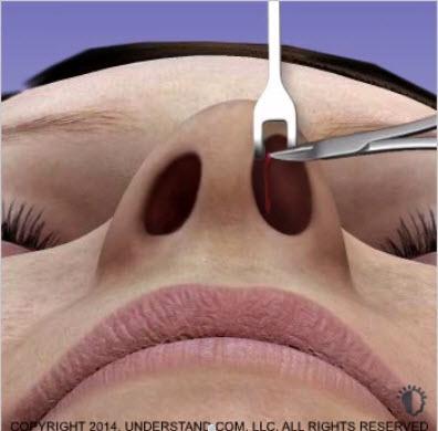 Incisión y formación del bolsillo para el implante nasal En el procedimiento de implante nasal, se crea un pequeño bolsillo en el que se colocará el implante.