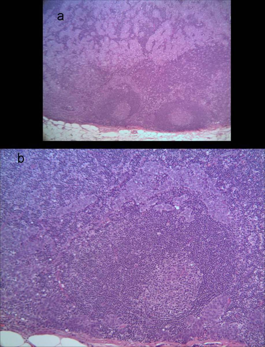 Fig. 6: Biopsia ganglionar postvaciamiento axilar : fig 6a.