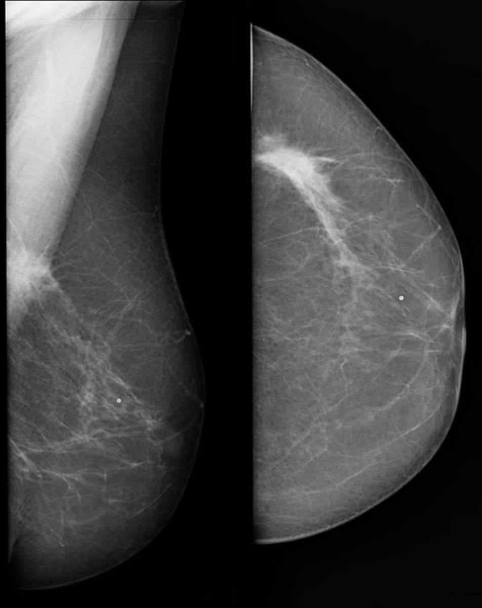 Fig. 3: Mamografía OML y CC de mama izquierda: Lesión