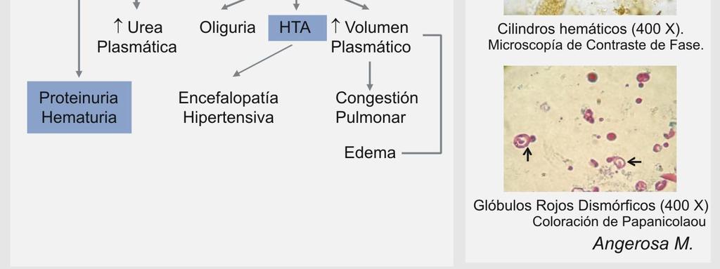La lesión glomerular genera proteinuria de margen nefrítico (< 3 g/24 hs), y hematuria dismórfica o de origen glomerular, y cilindros hemáticos.