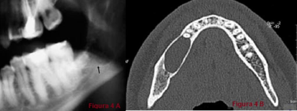 Fig. 3: Quiste radicular: -Figura 3A: Ortopantomografía que muestra al primero y segundo premolares con amplia destrucción de las coronas.