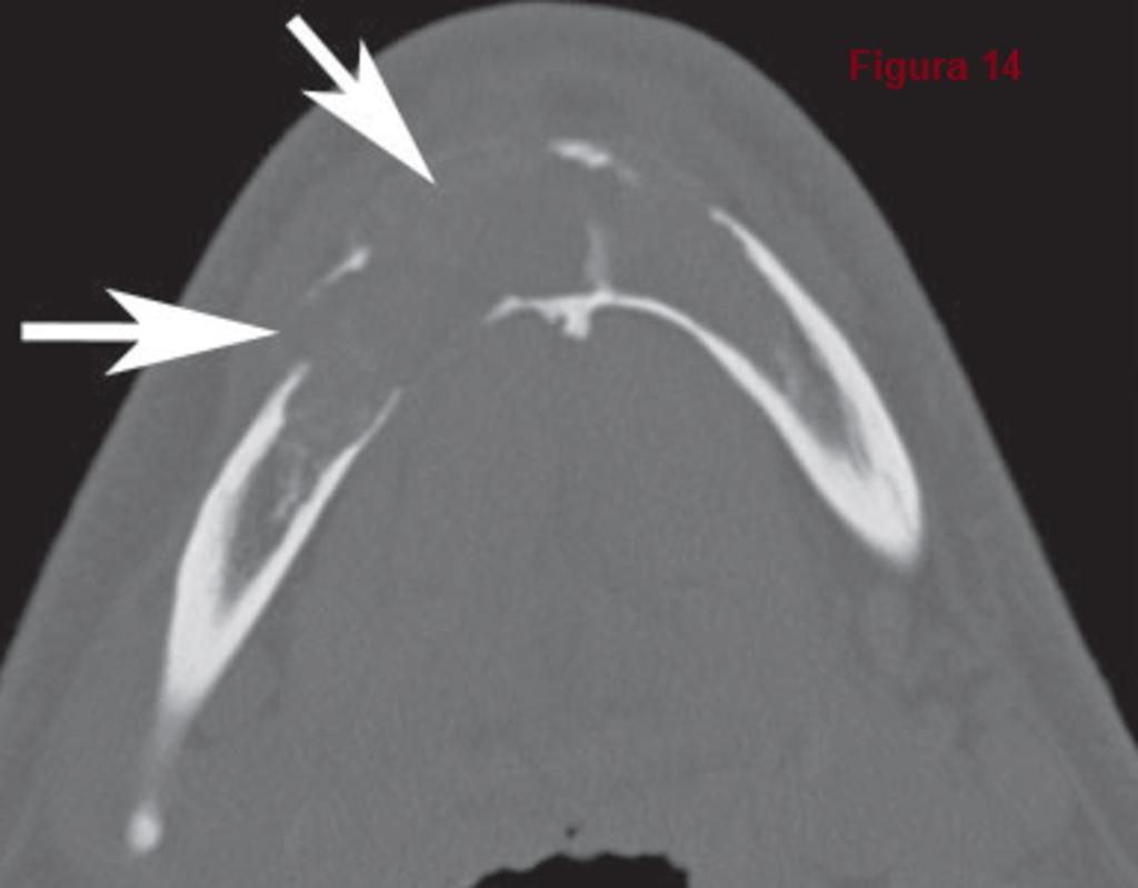 Fig. 14: Granuloma central de células gigantes: El corte axial de TC(ventanas hueso) demuestra una lesión