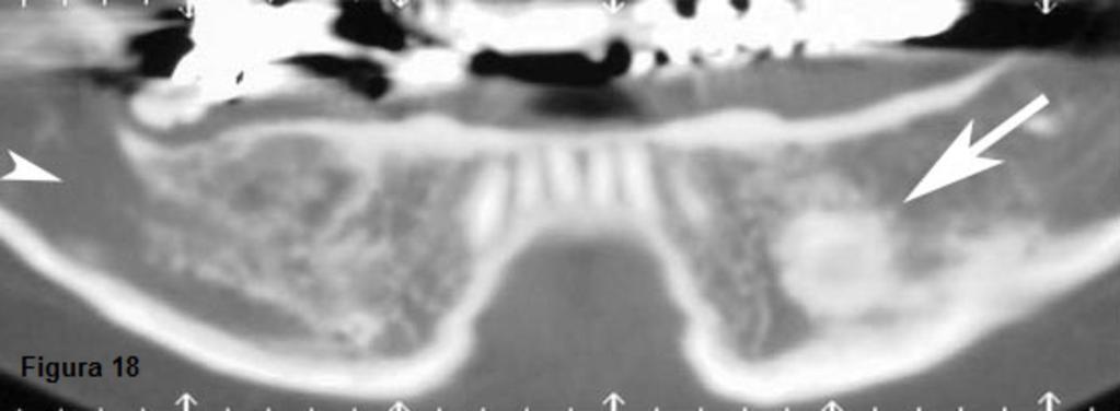Fig. 17: Osteosarcoma en ángulo mandibular izquierdo: se visualiza una tumoración lítica y con captación heterogénea tras la administración de contraste intravenoso.