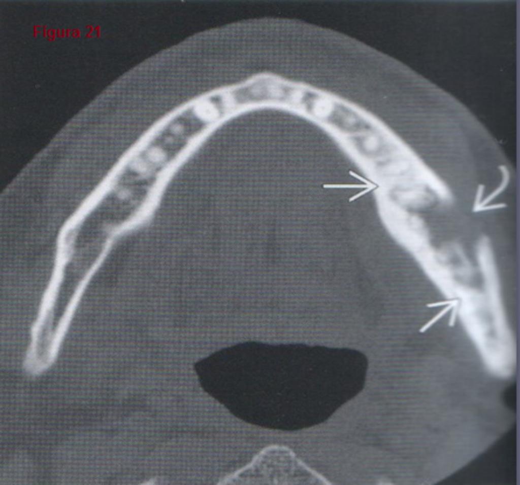 Fig. 21: Osteonecrosis de mandíbula: la TC ósea axial muestra un caso típico de osteonecrosis mandibular relacionada con la administración de bisfosfonatos.