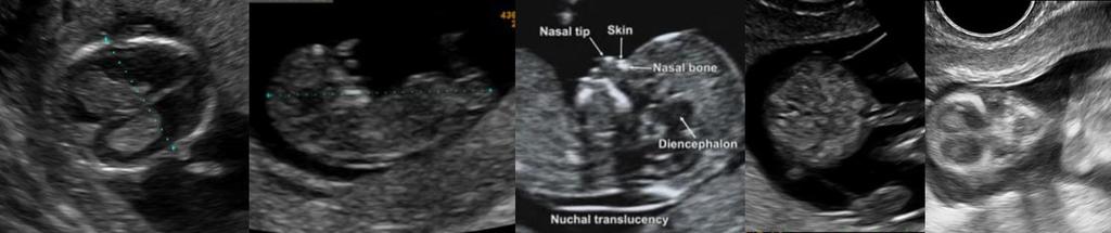 Si la situación fetal, la edad gestacional y la transmisión lo permiten, se captarán imágenes o clips que permitan evaluar otras estructuras anatómicas: riñones, diafragmas, corazón.