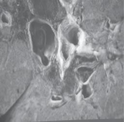 CUERVO F. Y COLS. Imagen 2 y 3. Presencia de trombos en ramas principales de las arterias pulmonares.