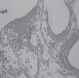 siguientes. Imagen 7. Metaplasia escamaso del epitelio alveolar. Coloración HE 10X. Imagen 4.