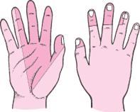 Figura 3 Cuando la presión es lo suficientemente elevada para alterar la función del nervio, es posible sentir adormecimiento (hipoestesia), corriente (hiperalgesia) y dolor en la mano y dedos.