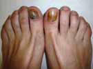Signos clínicos principales: - Onicolisis traumática: puede ser distal, si el despegamiento es causado por compresión del pulpejo distal por zapatos pequeños; o lateral si hay una sobreposición del