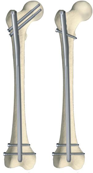 Referencias Implantes Clavo femoral de Reconstrucción anterógrado Colocación sencilla de tornillos canulados Tornillos canulados de 6,5 Inserción a través de agujas de Kirschner Perfeccionamiento del