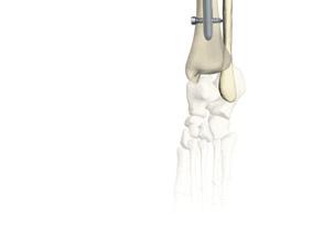 Referencias - Implantes Clavo para artrodesis Reducción de la curva de aprendizaje Se coloca con el instrumental estándar para clavo femoral T2.