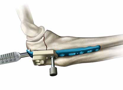 Flexione el codo 90, reduzca la fractura y aplique la placa. Las puntas del extremo proximal de la placa deben penetrar en el tendón del tríceps y proporcionar una fijación provisional.