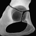 Desarrollo del hueso coxal En bebés y niños los huesos de la cadera incluyen tres huesos separados por el CARTÍLAGO TRIRRADIADO en el acetábulo En la pubertad