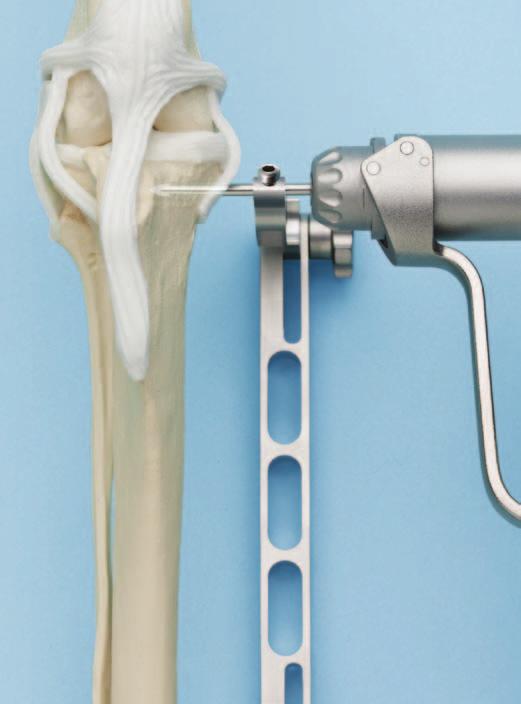 Identifique el ligamento lateral interno (LLI). Coloque una aguja de Kirschner de 3 mm (clavija de soporte) a través del agujero proximal del brazo del soporte de TPLO.