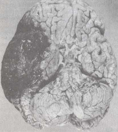 PATOGÉNESIS Lesión cerebral primaria Lesión