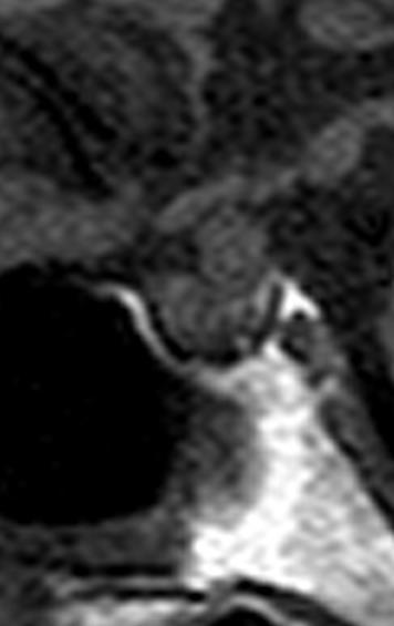 La mayoría se asocia a asfixia perinatal, trauma o parto de nalgas con disrupción del eje hipotálamo-hipofisario.