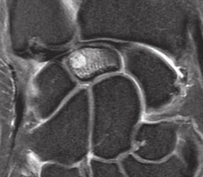 Imagen coronal T2W que muestra la variante cubital positiva que da lugar al desgarro del fibrocartílago triangular (punta de flecha) e impactación